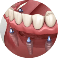 Implant-supported dentures